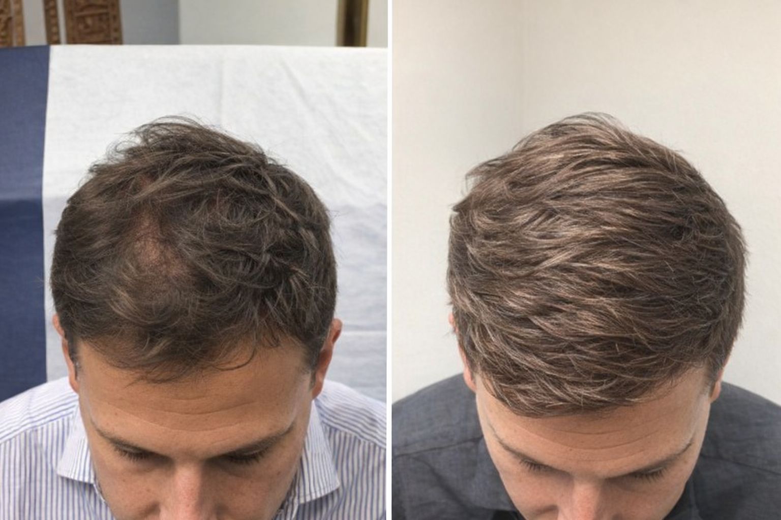 Före- och efterbild av en man som genomgått en hårbehandling för ökad densitet.